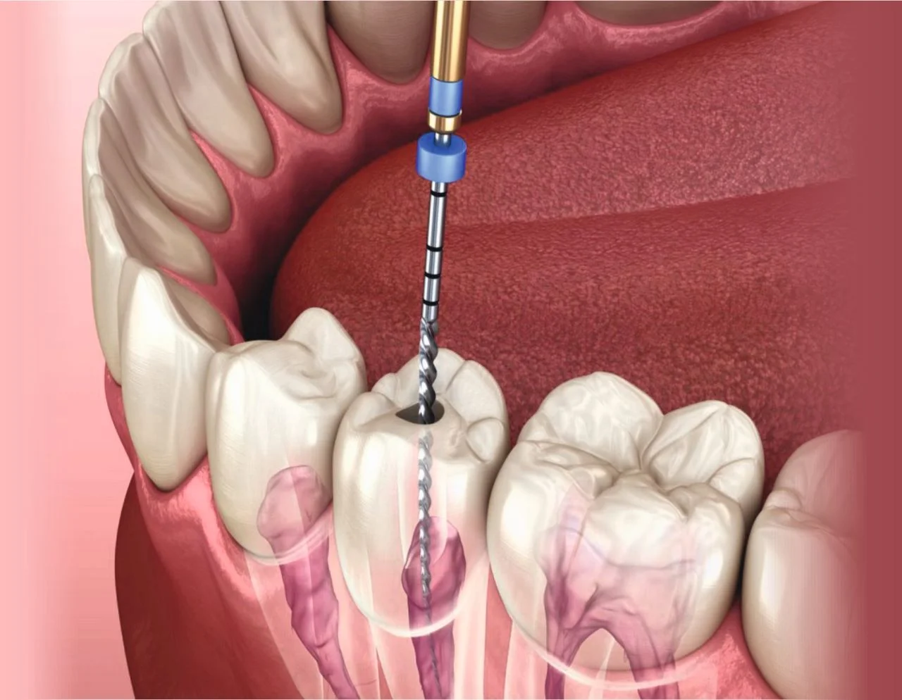 Root Canal Treatment